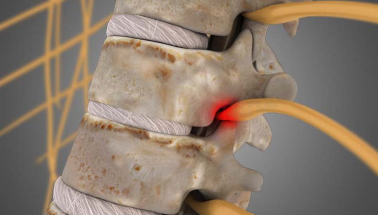 Read more about the article Lumber Spondylitis