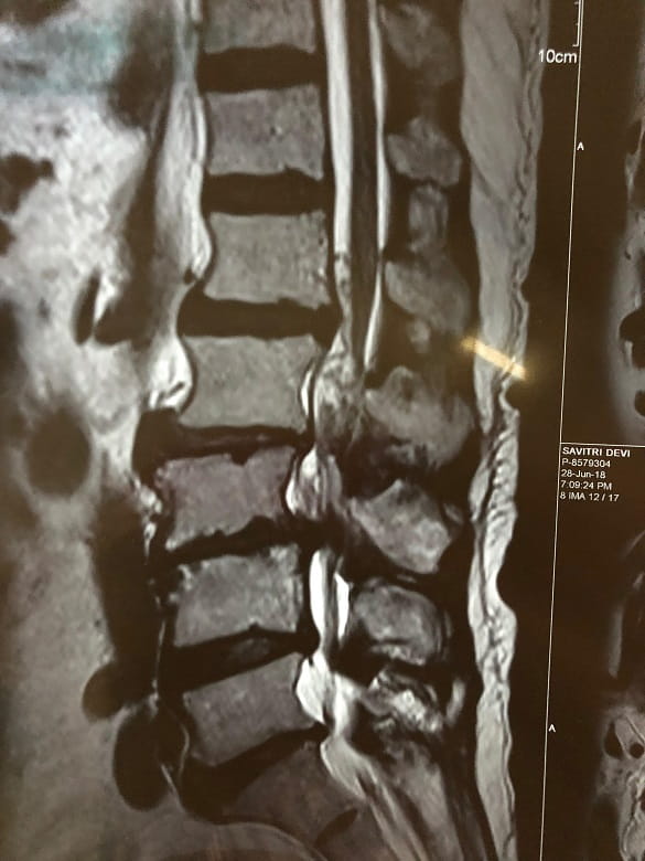 Lumber canal stenosis LCS