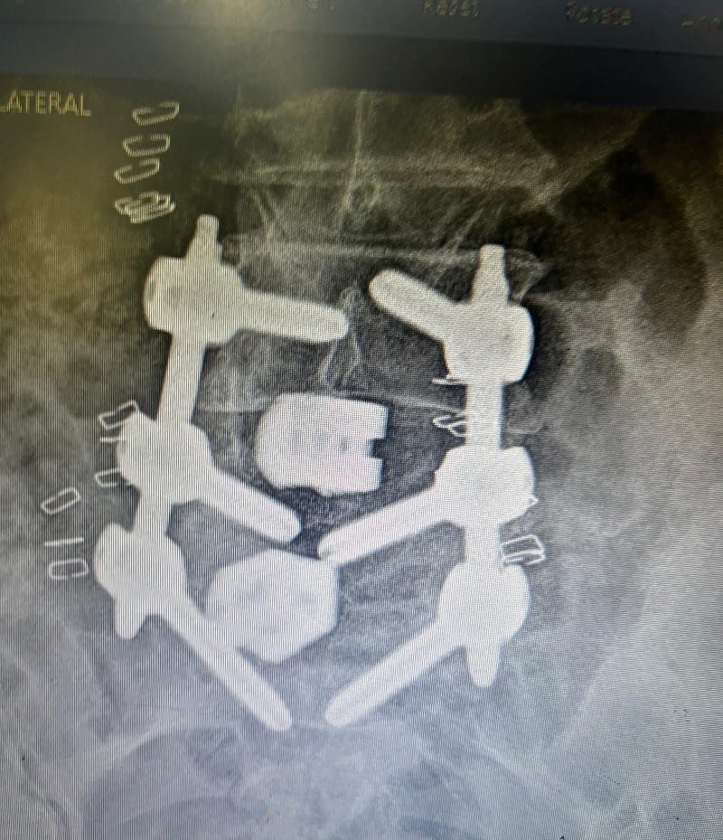 MIS PLIF Surgery